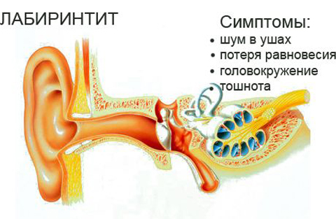 Головокружение при патологии уха